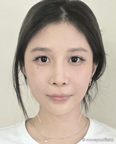無創徒手小顏術 下顎線收窄個案 療程後(客人同意刊登)