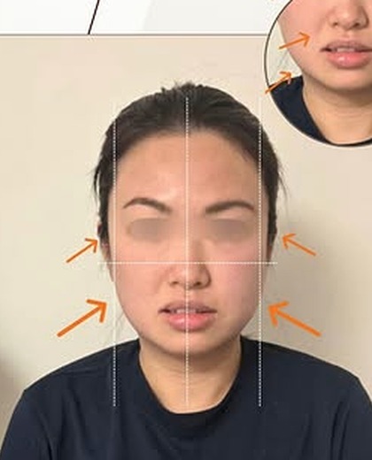 無創徒手小顏術 輪廓線調整個案 一次療程後（眼部已遮蔽保護私隱）