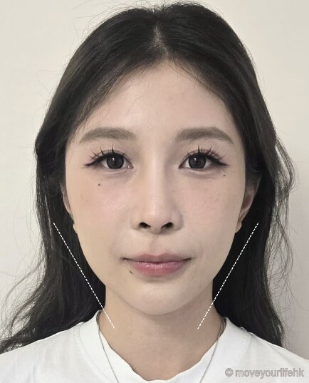 無創徒手小顏術 下顎線收窄個案 療程前(客人同意刊登)